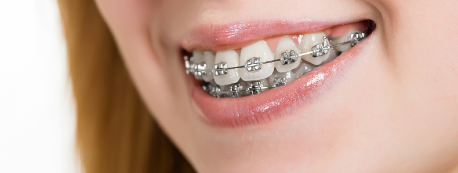 How your orthodontist can help treat sleep apnea Bedminster Orthodontics